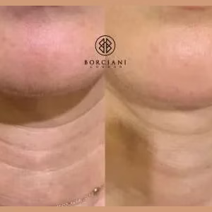Skin Tightening neck