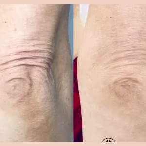 Skin Tightening Elbow