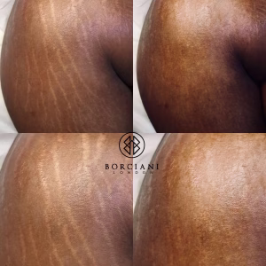 stretch mark treatment before and after
