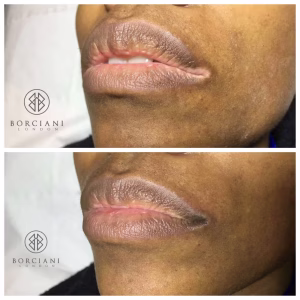 vitiligo before and after