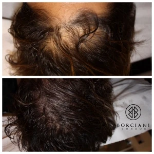 hair loss gallery